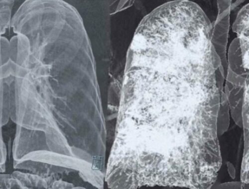 I polmoni dei pazienti post Covid-19 restano compromessi da grosse cicatrici, peggiori dei fumatori